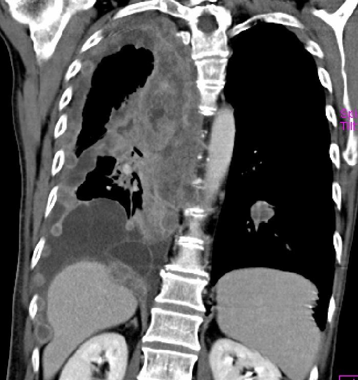 The most common imaging manifestations of MPM Pleural effusion Pleural thickening Ipsilateral volume loss Local invasion