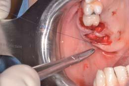 Con queste prerogative si consiglia l utilizzo in chirurgia implantare, parodontale e micro-chirurgia in