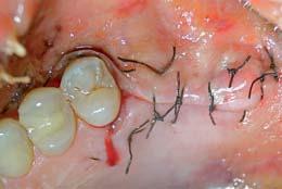 il rischio di inglobare la placca. Elevata forza tensile e assorbimento prolungato per idrolisi.