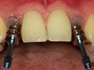 È una delle anomalie dentali più comuni ed è una patologia che può avere gravi conseguenze per la qualità della vita dei pazienti, in