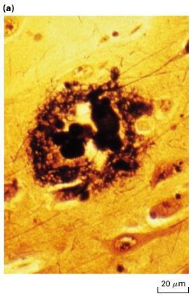 Proteine conformate in modo aberrante