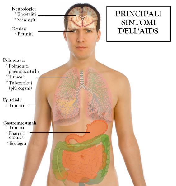 PATOLOGIE DEFINENTI AIDS HIV cachessia Polmonite Pneumocystis Polmonite ricorrente HSV cronico o di durata > 1 mese.