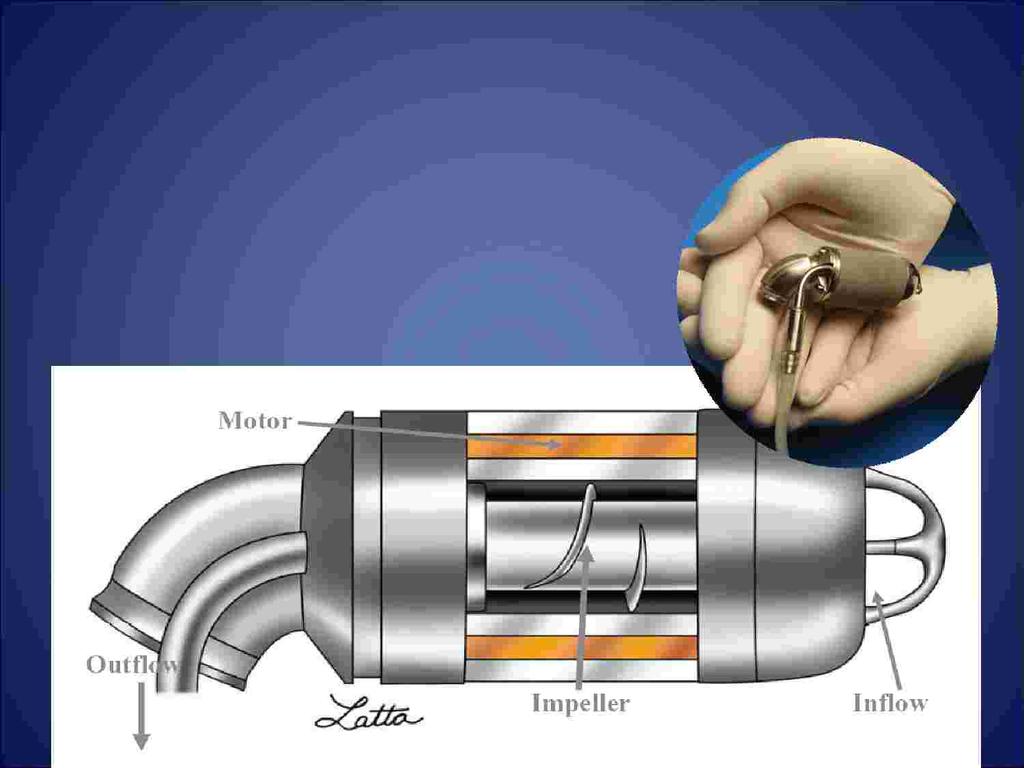 Rotor speed rotation is between 8,000 to 12,000 rpm