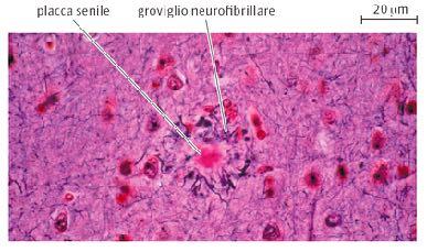 Quando il cervello si inceppa COLLEGAMENTO salute Morbo di Parkinson Disturbo motorio