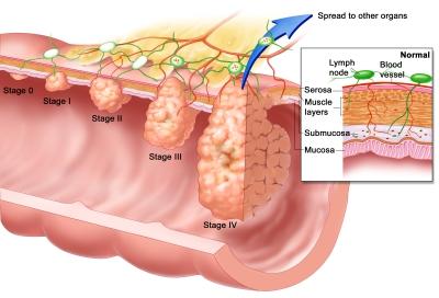 Approfondimento diagnostico (II livello) Colonscopia Biopsia Se colonscopia non è