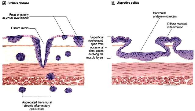 Inflammatory