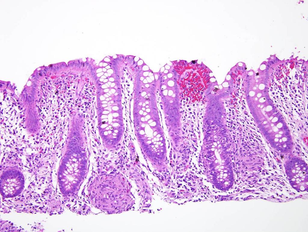 Crohn s colitis