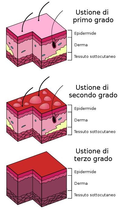 Ustioni: classificazione 36 I grado (superficiale a spessore parziale): riguarda solo l epidermide. La guarigione richiede solitamente da due giorni a due settimane e avviene senza lasciare cicatrici.