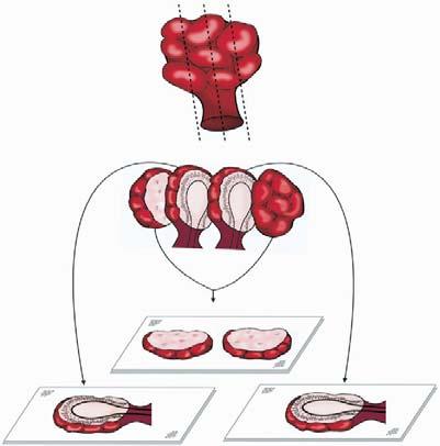 Campionamento del Polipo: la teoria (letteratura) Prelievo centrale medio-sagittale e sezioni parallele ogni 2 mm con calotte laterali residue incluse a parte Fenoglio Gastrointestinal Pathology: An