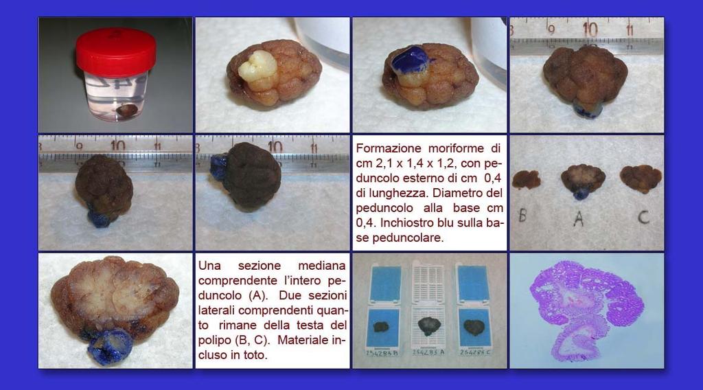 Sezione in tre o pù fette di 2 mm di spessore mediante sezione sagittale