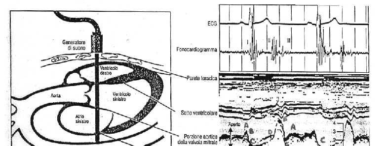 ECOCARDIOGRAFIA Ultrasuoni attraverso la parete toracica vengono riflessi come echi dalle strutture interne.