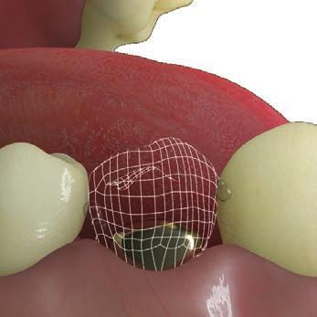 della corona provvisoria Impronta digitale Riposizionamento della corona provvisoria su iphysio