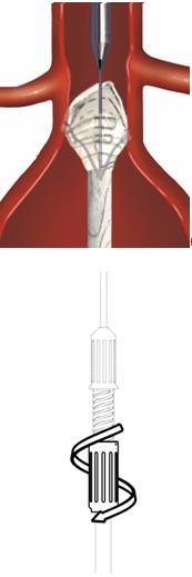 Avvertenza Non spingere l intero sistema prossimalmente per evitare di distorcere il collo del dispositivo e causare endoleak. Ruotare lentamente il controllo della guaina in senso antiorario.