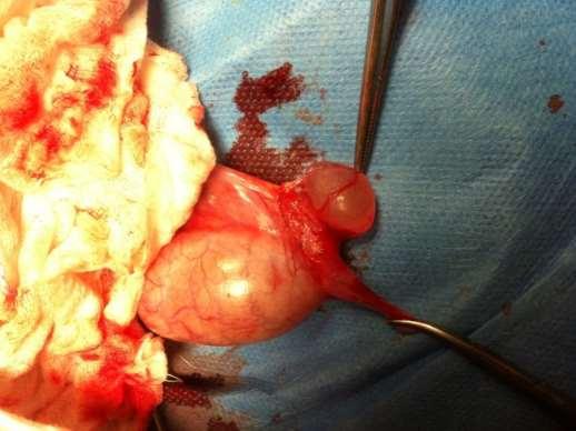 Idatide di Morgagni: reperto intraopertorio Causa più frequente di scroto acuto in