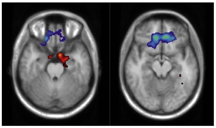 NEUROIMMAGINI E PSICOTERAPIE ETCR-fMRI Peres