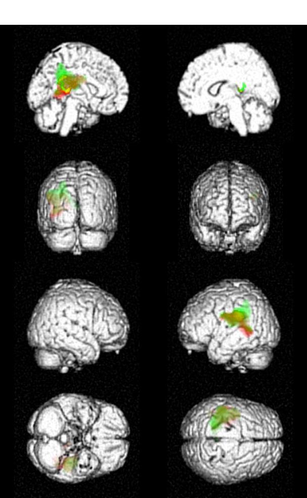 IMPATTO DEL PTSD, DELLA IES E