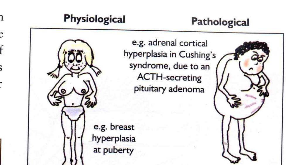 ormonale; es iperplasiabenigna-dell endometrio per eccesso assoluto o relativo di estrogeni/iperestrogenismo -lesione precancerosa) riparazione delle ferite (da eccesso di fattori di crescita)