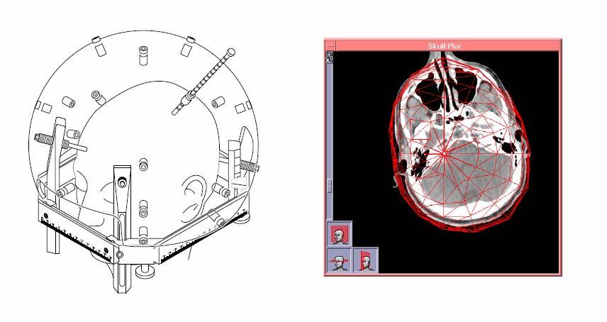 Capitolo 3 La Radiochirurgia Stereotassica con Gamma Knife eseguita, deve sovrapporsi all immagine ottenuta dalla TC (Figura 3.13). Figura 3.13: Determinazione delle dimensioni della scatola cranica.