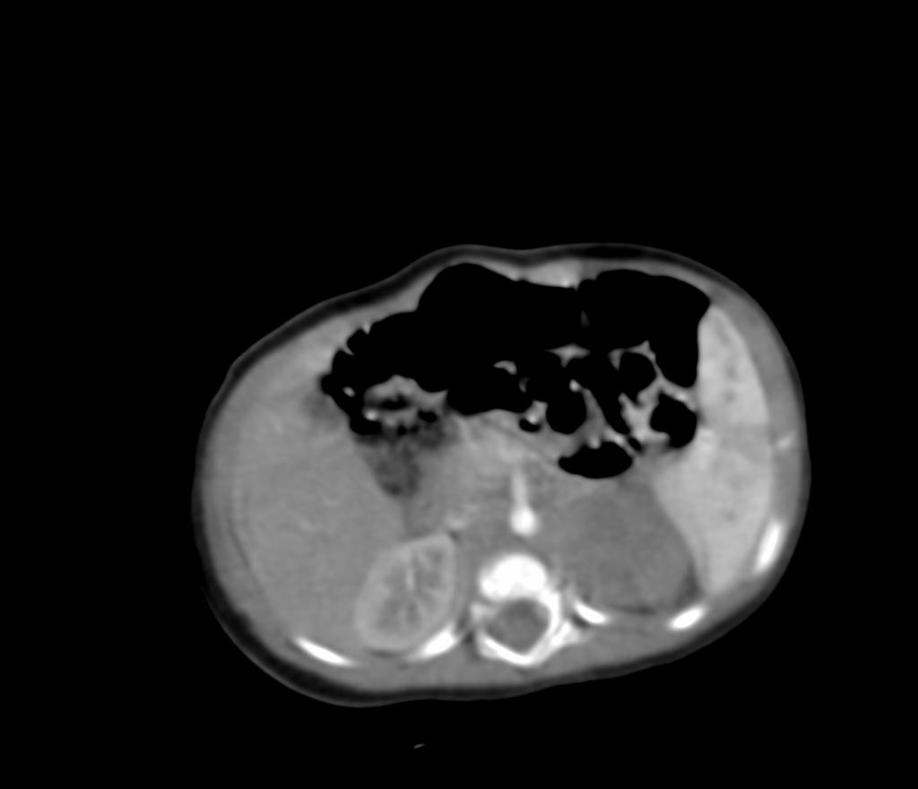 Giulia: 5 mesi Istologia: Neuroblastoma a prognosi favorevole Oncogene MYCN non