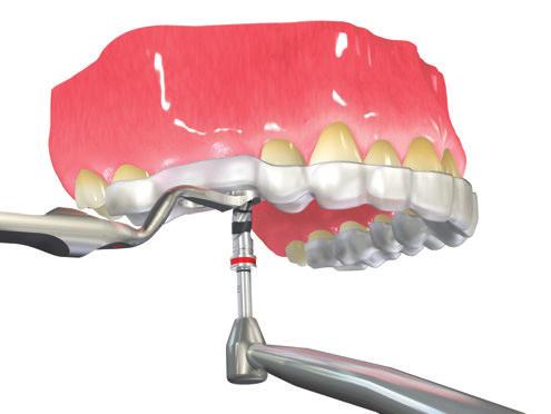 Molto di più di efficienza durante l'intervento chirurgico. Straumann Guided Surgery.