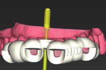 D Mascherina chirurgica digitale stampata, con la soluzione Straumann CARES X-Stream