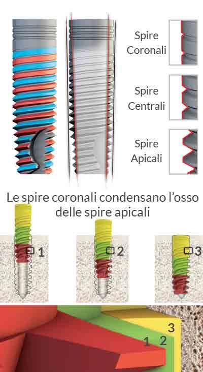 Connessione a Esagono interno ATID Micro anelli* Bone platform shifting Superficie porosa sino alla testa dell impianto PARTE CORONALE Superficie di appoggio più ampia Minore riassorbimento crestale