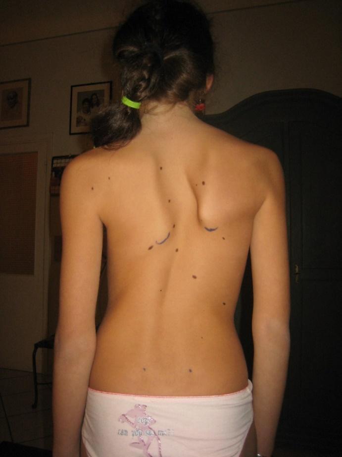 Esame clinico accurato: -allineamento spalle -allineamento scapole -simmetria