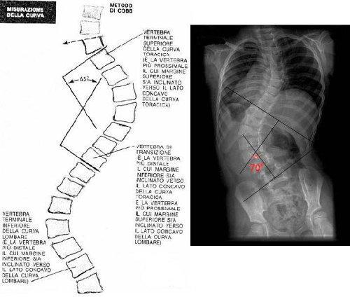 METODO di COBB Una linea si traccia sulla endplate superiore della vertebra limitante ( cioè più