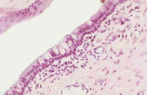 adenoideo: tessuto fibroso con linfociti (follicoli), fibroblasti,