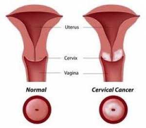 rrggtgtgtg Chirurgia Radioterapia La pietra angolare del trattamento Il campo di irradiazione deve chirurgico primario del cervicarcinoma comprendere utero (quando presente), in stadio precoce rimane