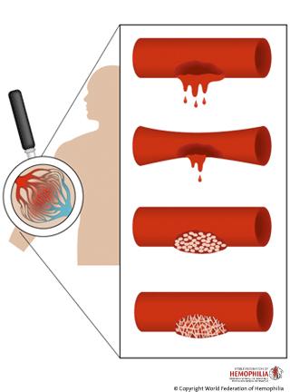 Sedi: articolazioni: caviglie e ginocchio (più frequenti nel