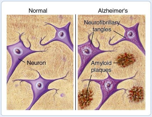 Parkinson e Alzheimer