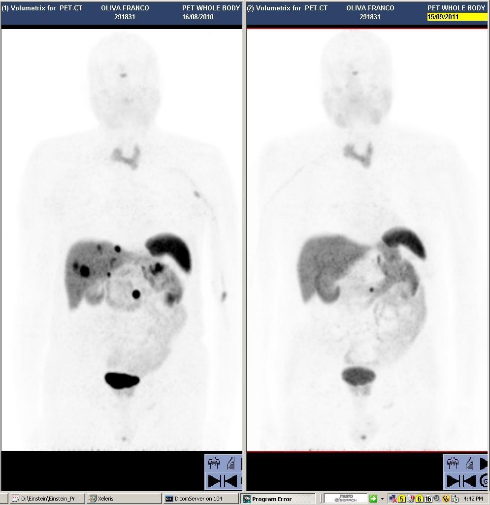 68Ga-DOTATATE PET/CT Pre-terapia Post-terapia M, 73 aa: Carcinoma neuroendocrino