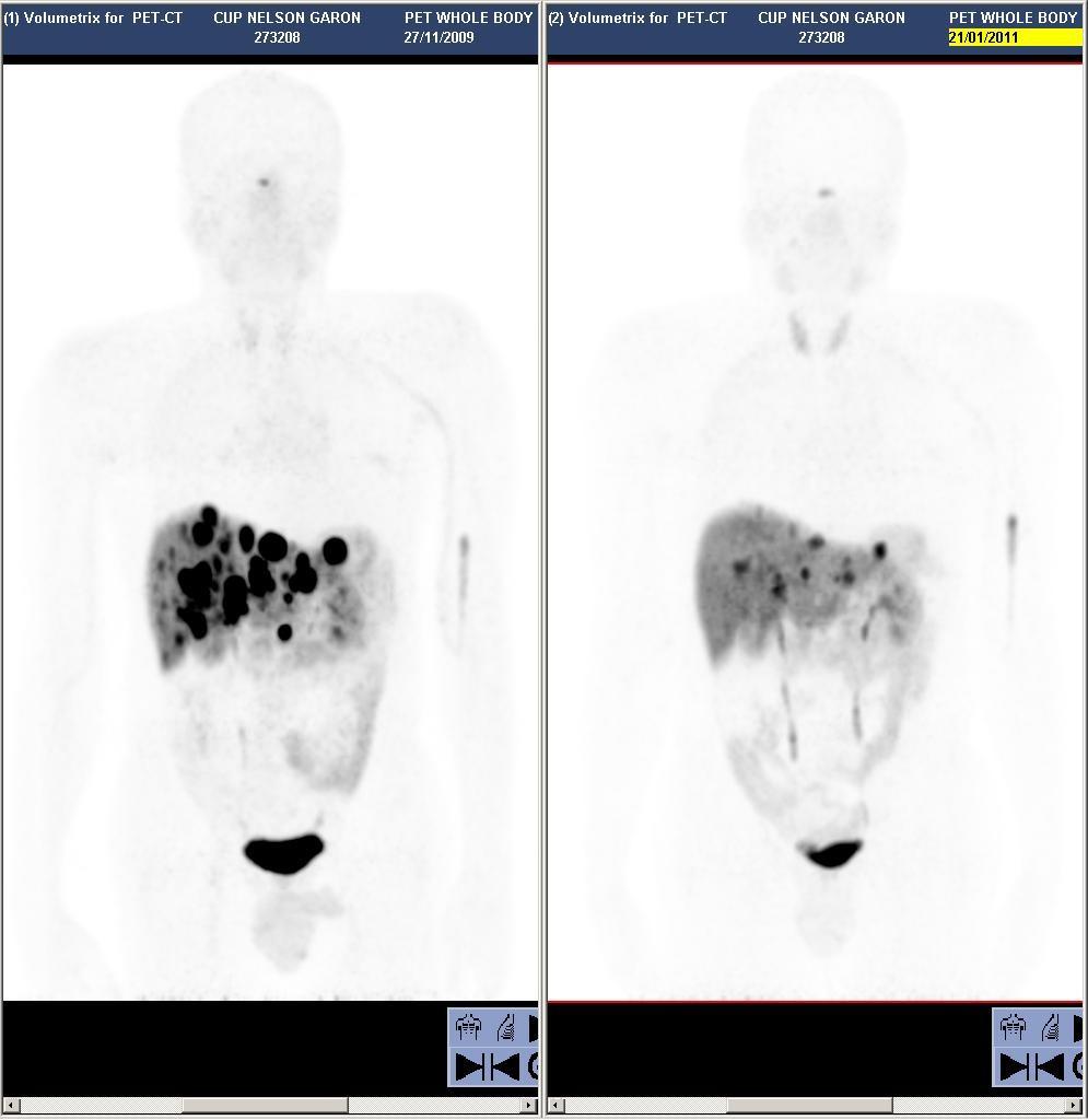 68Ga-DOTATATE PET/CT Pre-terapia Post-terapia M, 56 aa: carcinoma neuroendocrino