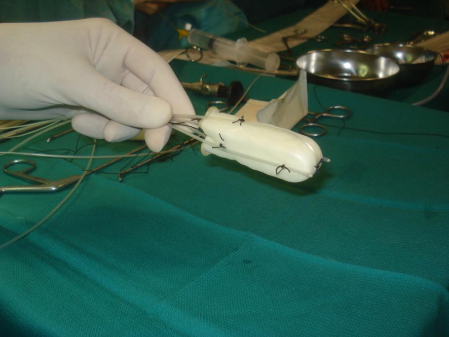 Endoscopic Guided Brachytherapy