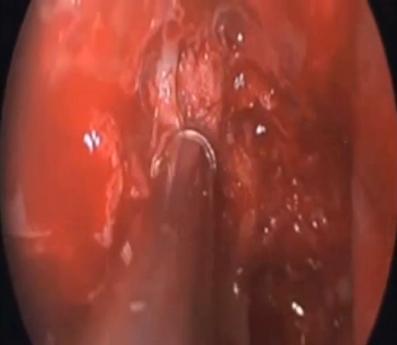 Endoscopic Guided