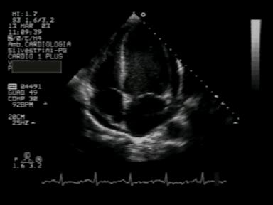 REGOLA Situs addominale = Situs toracico = Situs atriale Auricola dx : larga,