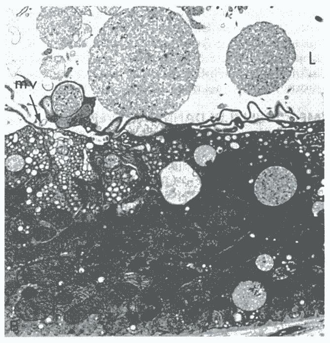 Danno cellulare irreversibile: è associato morfologicamente a rigonfiamento mitocondriale (vedi figure riportate), danno esteso alla membrana plasmatica e rigonfiamento dei lisosomi.