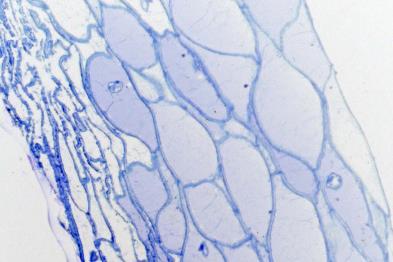 2005 Biopsy: June, 2005 LM, 20 X