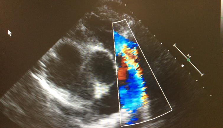 Stenosi polmonare Forme non significative : - gradiente di picco < 30 mm Hg - idoneità a tutte le attività sportive (test ergometrico massimale negativo) Forme moderate: - gradiente picco >30 e <50