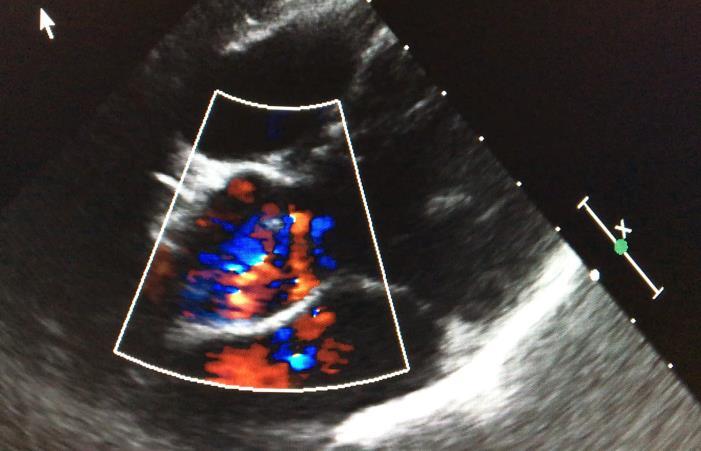 Valutazione della severità dell insufficienza aortica Lieve se : - morfologia del jet sfumato - piccolo centrale al color doppler - vena contratta <3mm - PHT > 500 m/s - area orifizio rigurgitante