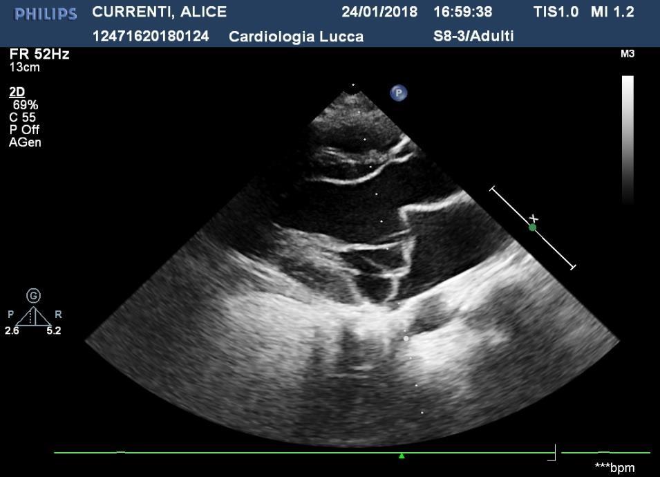 Prolasso della mitrale Criteri ECO diagnostici: - Ridondanza (billowing) dei lembi - Ispessimento valvolare con spessore max della porzione media dei lembi > 5 mm - Spostamento posteriore sistolico >