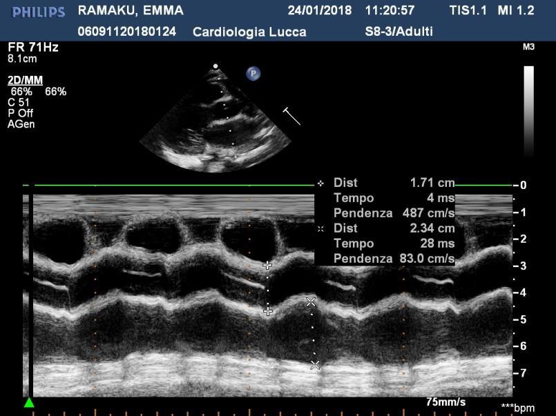 Sx - rapporto atrio sx/aorta è 1.5-2 (severo se >2) - insuff.