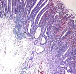 HIGH-GRADE NEOPLASIA high grade adenoma high