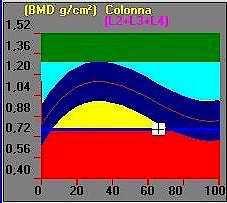 MINERALOMETRIA OSSEA (MOC) BMD (g/cm2) Normale: scostamento del BMD non superiore a 1DS (deviazione standard) dal valore medio per i giovani adulti Osteopenia: BMD tra 1 e 2,5 DS sotto la media