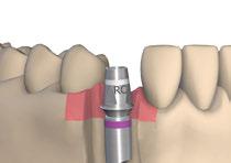 Corona singola Bone Level cementata Usando RC come esempio Prelievo dell impronta a livello dell impianto 2