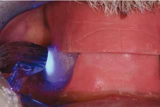 della RC Figg. 70 e 71 Fotopolimerizzazione della resina direttamente nel cavo orale a bocca chiusa Fig.