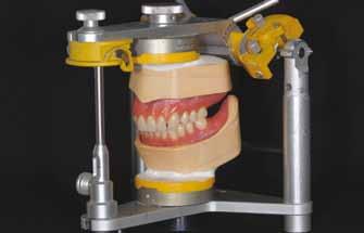Figg. 102 e 103 Montaggio dei denti posteriori superiori e modellazione individualizzata delle parabole e delle flange