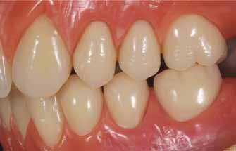 con ricostruzione delle guide funzionali Tornate le protesi in laboratorio, si termina il montaggio posizionando i denti