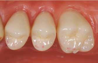 distali dei premolari inferiori e la cuspide mesiopalatale del primo molare superiore deve occludere nella fossa